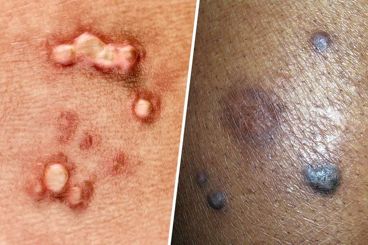 Can You Get Genital Warts from Toilet Seat? Myths vs Facts Explained