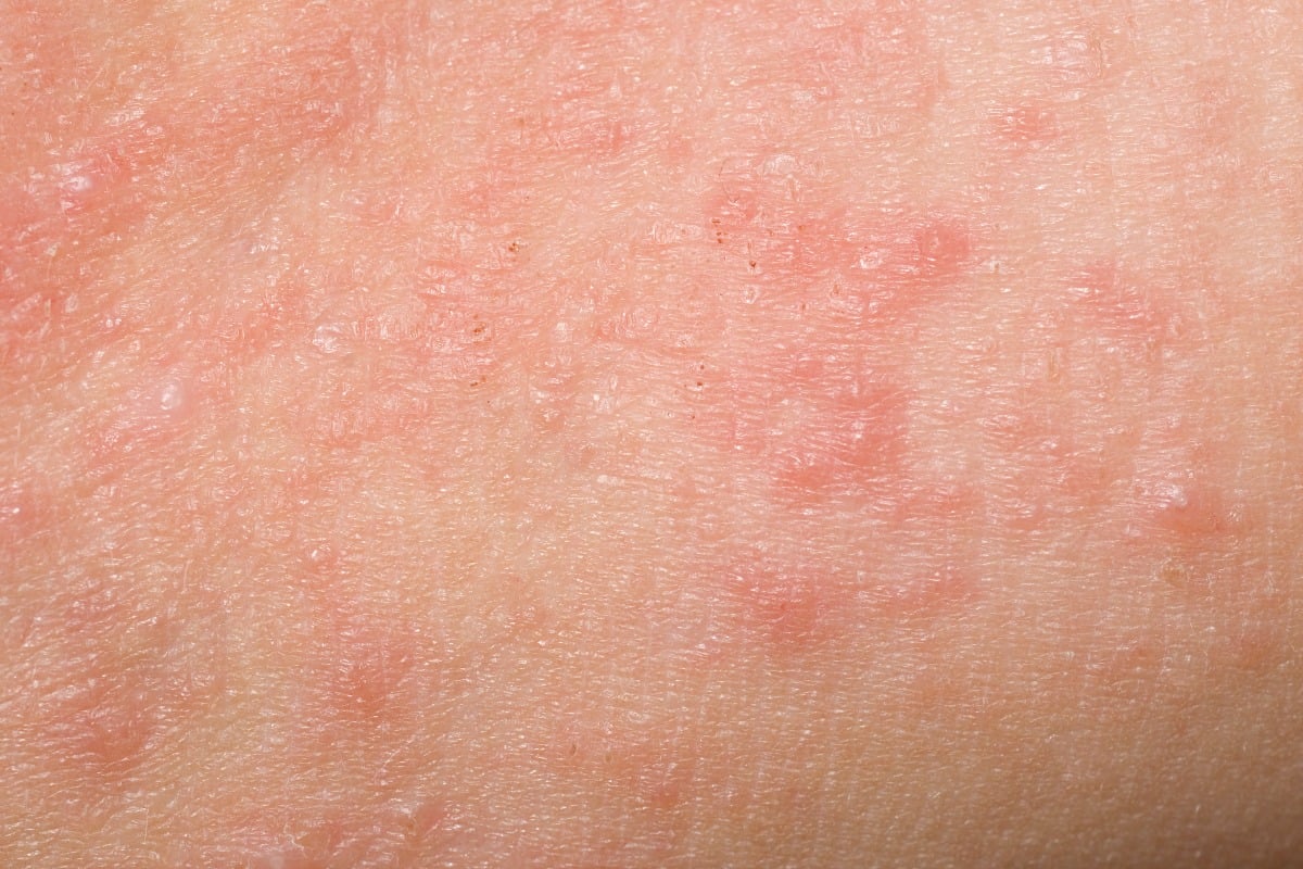 Can You Get Scabies from a Toilet Seat? Myths vs Facts Revealed